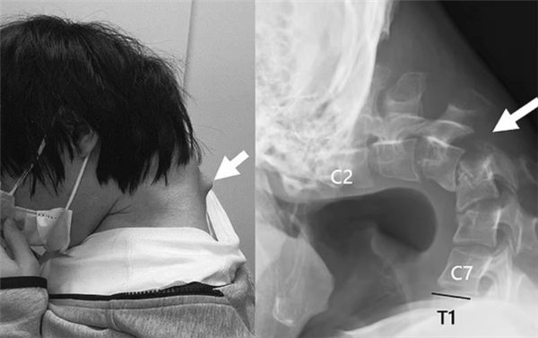 日本25岁男子沉迷手游致脖子长角：无法抬起头 出现吞咽困难(图1)